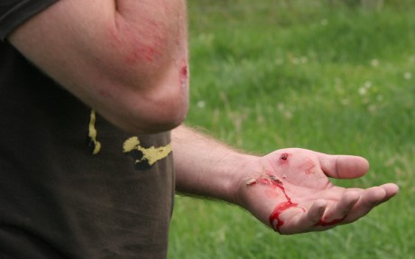 These injuries were caused when James Gill kicked this protestor causing him to fall against barbed wire