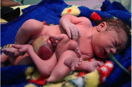 Doctors in Fallujah are registering hundreds of babies with severe birth defects, which they attribute to DU munitions and other war toxins (Dr Samira Alani/Al Jazeera)